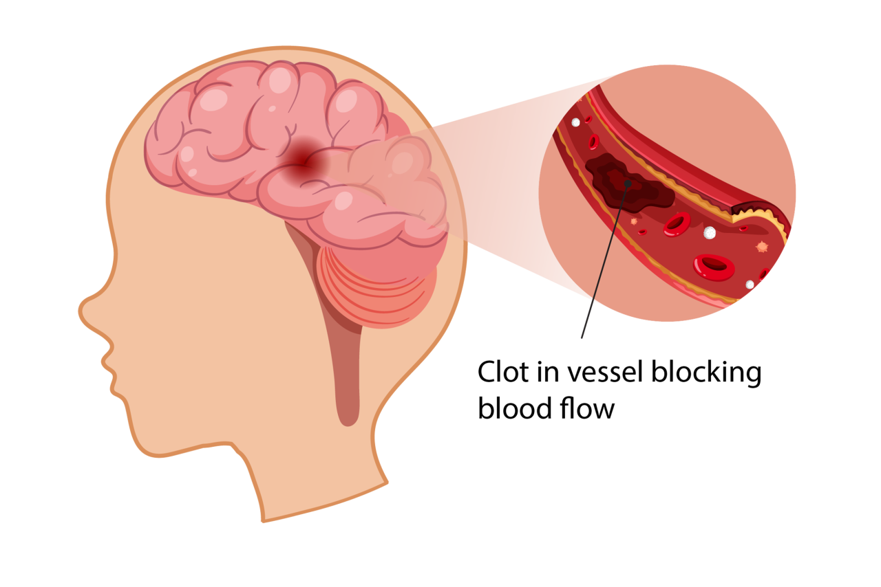 graphic illustration of the brain and a clot in a blood vessel