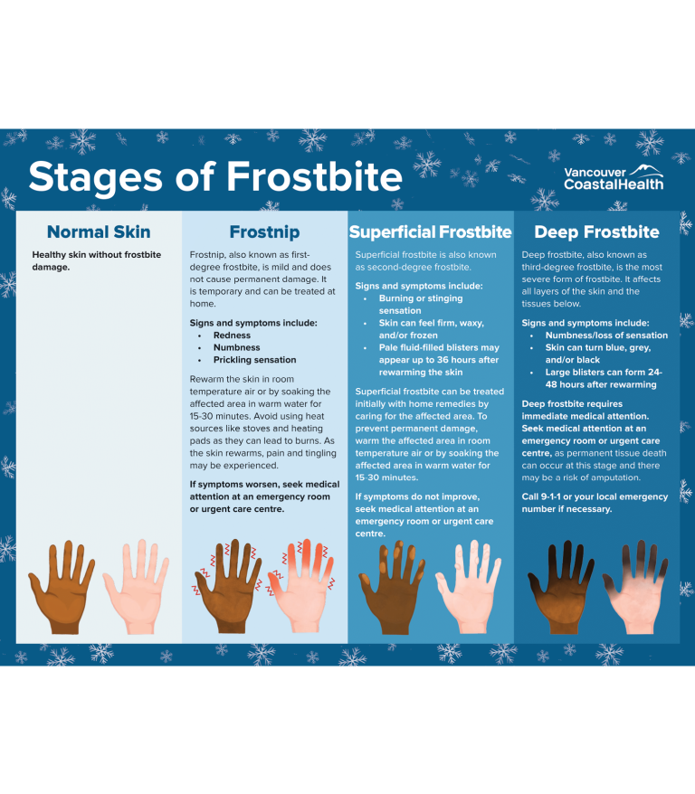 frostbite thumbnail