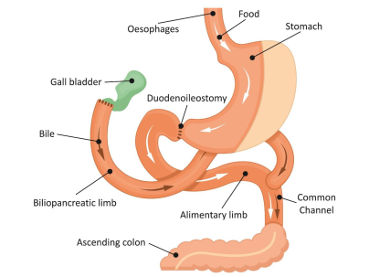 Illustration of the Laparoscopic BPD-DS procedure